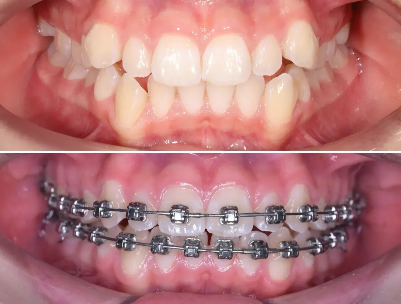Исправление мезиального прикуса у ребенка до/псоле